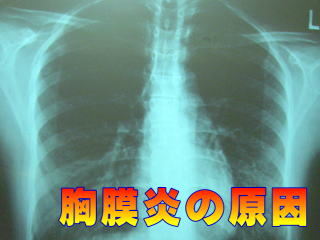 胸膜炎のＸ線写真