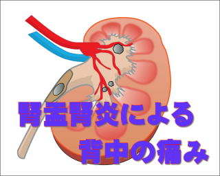 腎盂腎炎のイメージ画像
