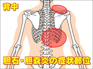 胆石や胆嚢炎の背中の症状部位