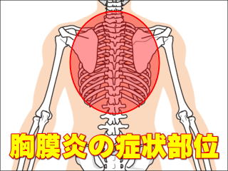 胸膜炎の症状発現部位 / 背部