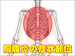 胸膜炎の症状発現部位 / 胸部