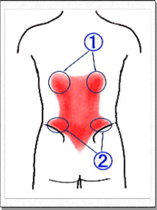 胸腰筋膜性腰痛の疼痛領域