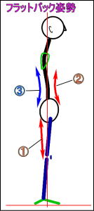 フラットバック姿勢イメージ図