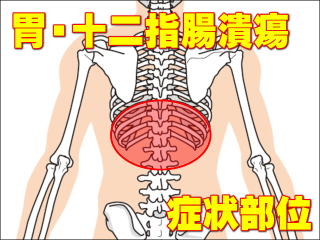 胃潰瘍・十二指腸潰瘍による症状部位・背部