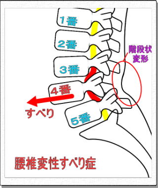 腰椎変性すべり症の模式図