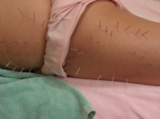 大腿外側と前方への鍼治療
