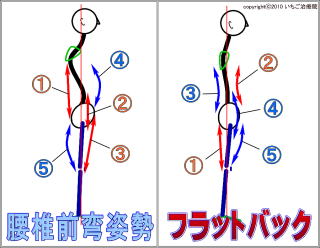 姿勢の比較・フラットバック姿勢と腰椎前弯姿勢の図