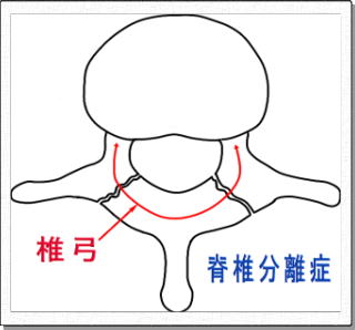 腰椎分離症模式図、水平断面