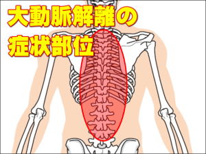 大動脈解離の症状部位 / 背部