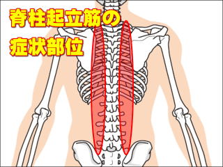脊柱起立筋の症状部位