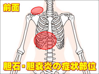 胆石や胆嚢炎の上腹部の症状部位