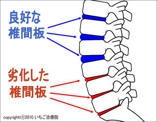 椎間板症模式図