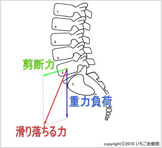 腰椎にかかる滑り落ちる力の模式図