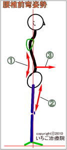 腰椎前弯姿勢イメージ図