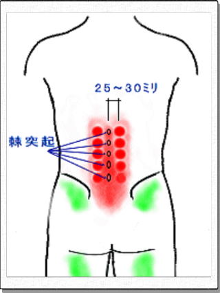 椎間関節性腰痛の疼痛領域
