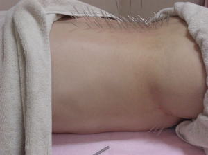椎間関節性腰痛への鍼治療の様子１